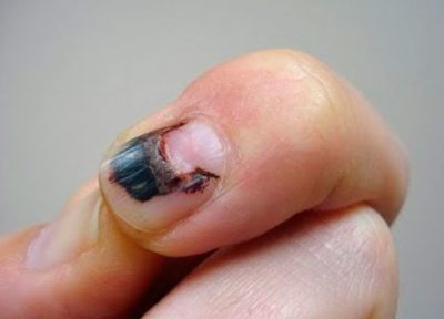 5 базовых причин возникновения белых полос на ногтях