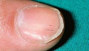 5 basic causes of white stripes on nails