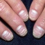 white stripes on nails