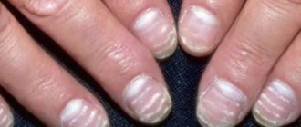 white stripes on nails