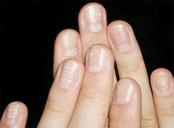 Белые пятна на ногтях сулят хорошие новости