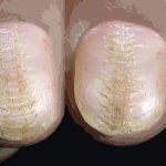 Beau-Reil&#39;s grooves or what do indentations on nails mean?