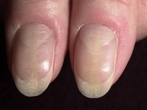 Often the growing nail can be deformed