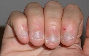 Чем опасна привычка грызть ногти