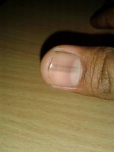 black spot under the nail