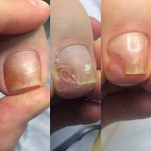 Фото: этапы слезания ногтя с пальца