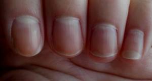 Fungus on nails