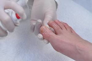 Как распарить ногти на ногах при грибке