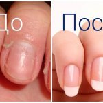 How to prevent the cuticle from growing?