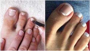 Correction of short toenails