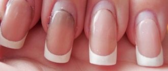 Correction of extended nails is necessary as they grow