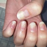 Некрасивые ногти после гель-лака