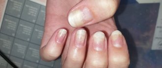 Ugly nails after gel polish