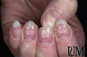unevenness on the nails