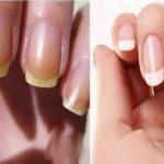 Nails turn yellow from exposure to negative external factors and health problems.
