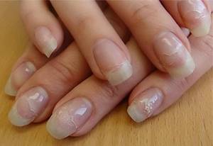Peeling gel nails