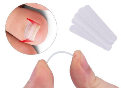 Пластины и нити для лечения вросшего ногтя