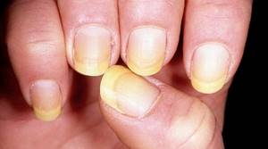 Почему желтеют ногти на руках у женщин 2