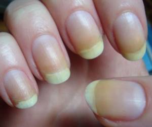 Popular cosmetic compositions for improving the nail plate