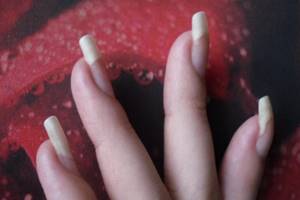 Причины онихолизиса - отслоения ногтей