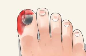 Causes of blackened toenail. Which doctor to see, treatment 