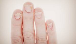 Причины вызывающие желтизну ногтей