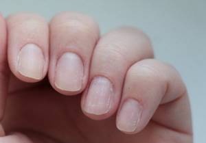 Peeling nails