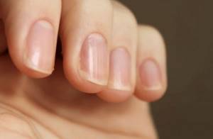What are vertical stripes on fingernails?