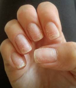pitting on fingernails: causes and treatment